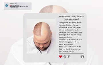 Why Choose Turkey for Hair Transplantation?