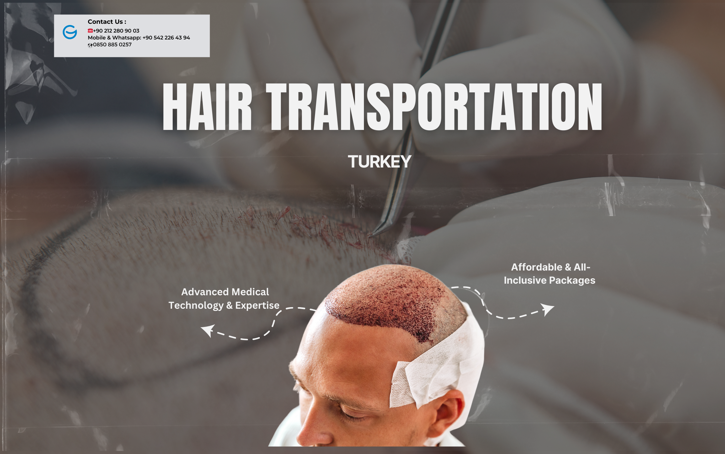 Trasplante de cabello en Turquía ¡excelencia y asequibilidad